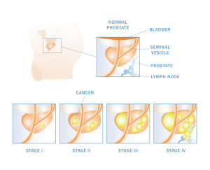 Michel-Prostate-Stages-Illustration-1-24-14