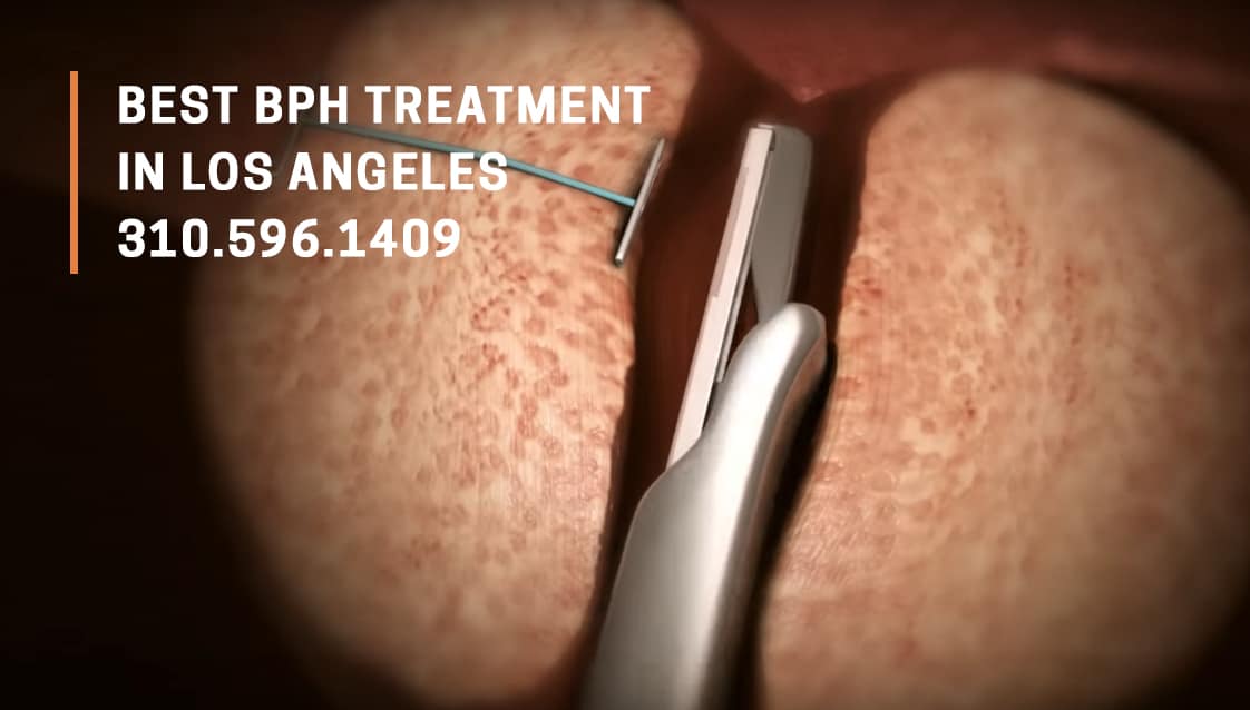 Best BPH Treatment in Los Angeles
