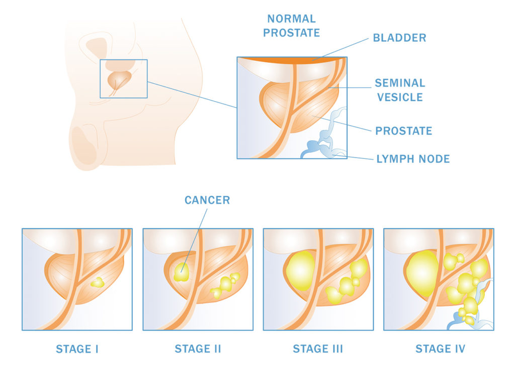 Prostate Cancer Grading and Staging