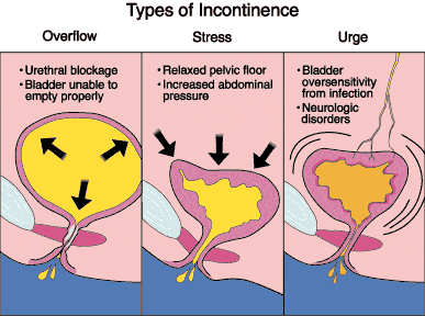 Different Types of Incontinence