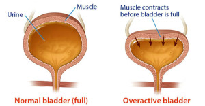 What-Causes-Overactive-Bladder-Blacklist-of-Foods-to-Avoid-It