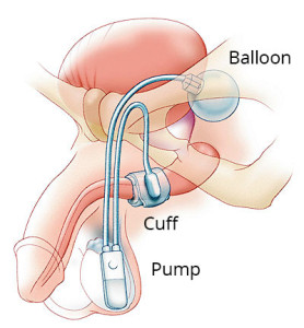 artificial-urethral-sphincter-diagram