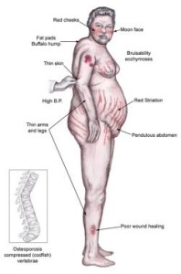 cushings-syndrome