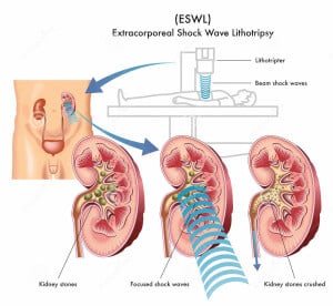 Extracorporeal Shock Wave Lithotripsy (ESWL) for Urinary Stone Treatment