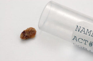 kidney stone removal surgery los angeles