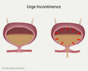 female urinary incontinence