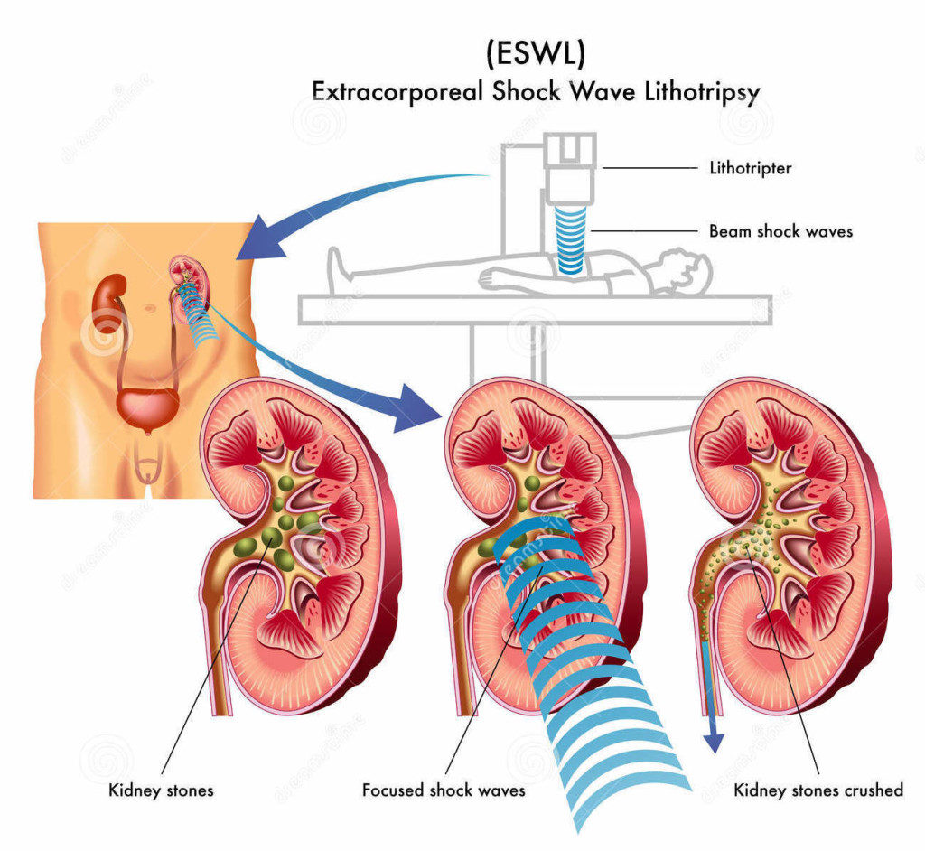 Kidney Stones Shockwave Treatment Beverly Hills