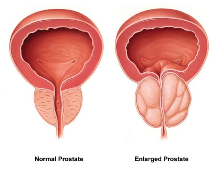 Los Angeles Prostate Urologist Diagnosis Center